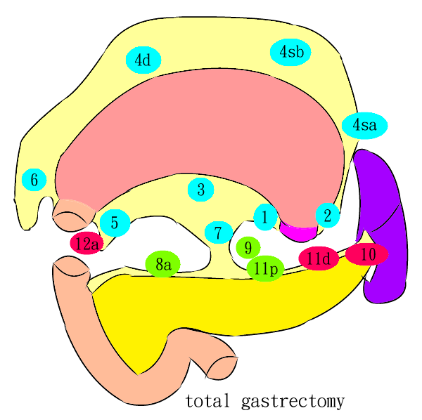 total gastrectomy (LN)